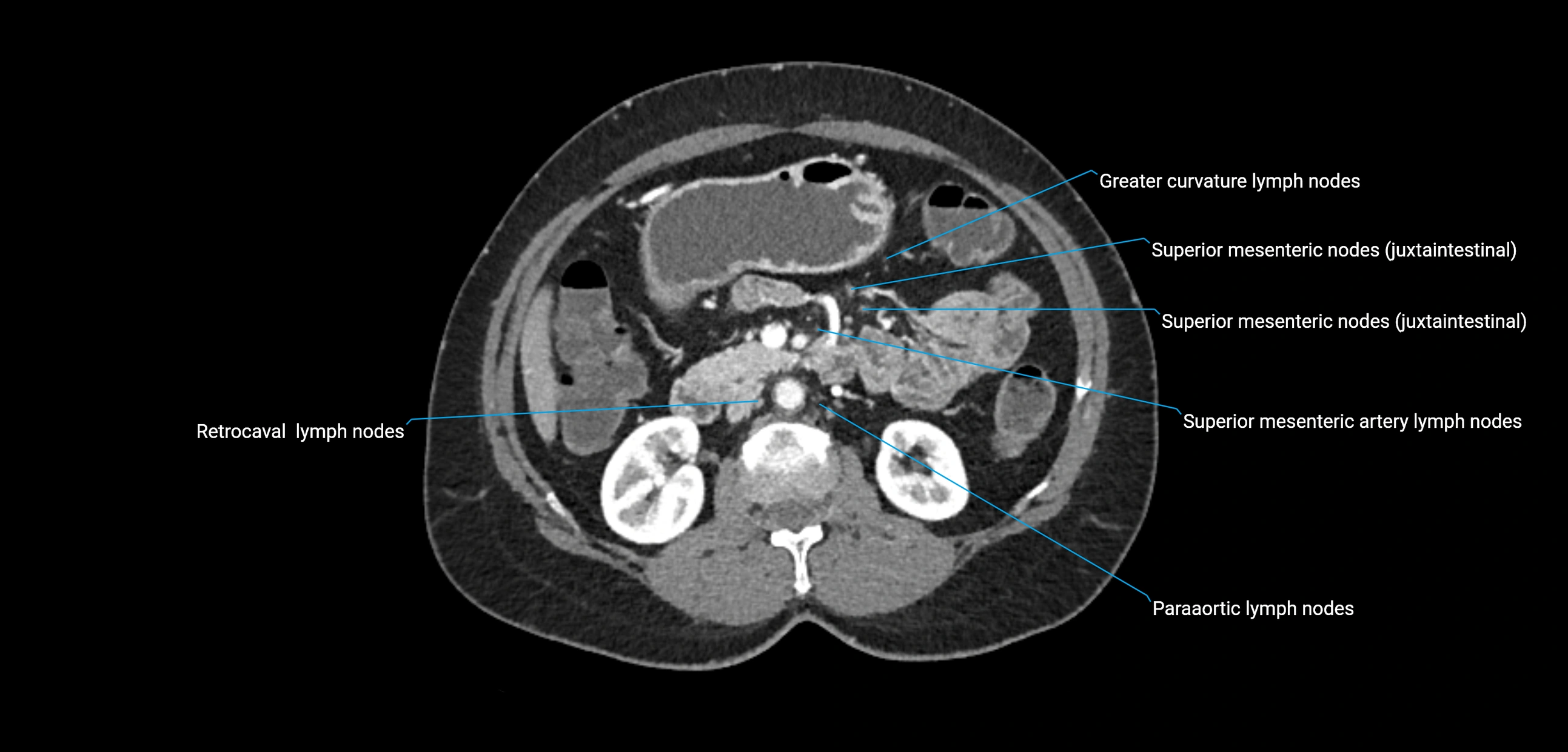 CT ct abdominal lymph nodes  axial cross sectional anatomy  enchanced radiology image -img-00002-00189.webp